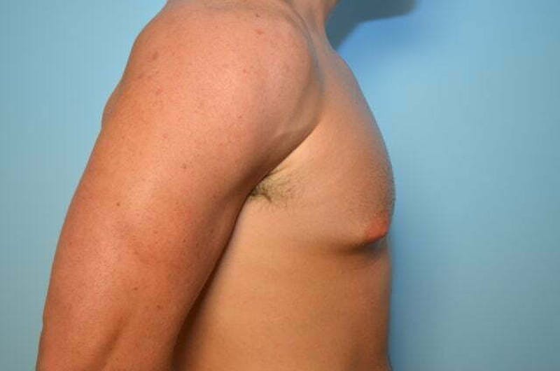 Male Procedures by Dr. Hess Before & After Gallery - Patient 273642 - Image 5