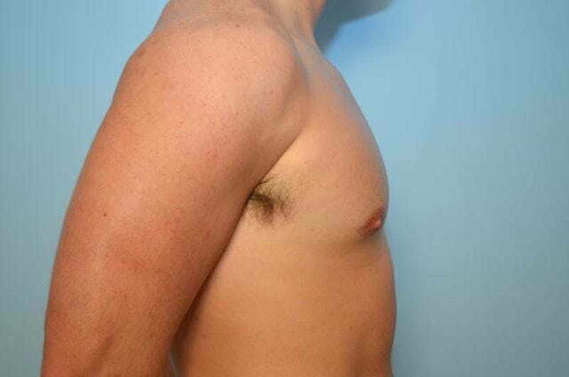 Male Procedures by Dr. Hess Before & After Gallery - Patient 273642 - Image 6