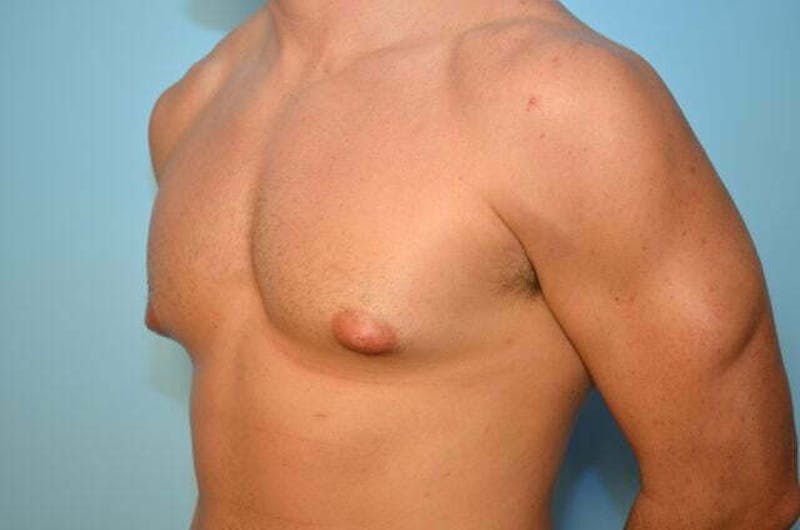 Male Procedures by Dr. Hess Before & After Gallery - Patient 273642 - Image 7