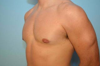 Male Breast Reduction Before & After Gallery - Patient 273642 - Image 8