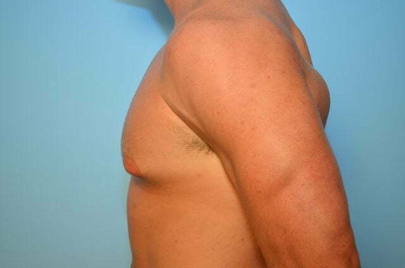 Male Procedures by Dr. Hess Before & After Gallery - Patient 273642 - Image 9
