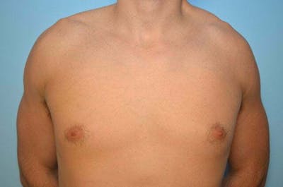 Male Procedures by Dr. Hess Before & After Gallery - Patient 264926 - Image 1