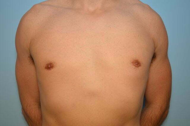 Male Procedures by Dr. Hess Before & After Gallery - Patient 264926 - Image 2