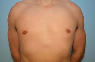 Male Breast Reduction Before & After Gallery - Patient 264926 - Image 2