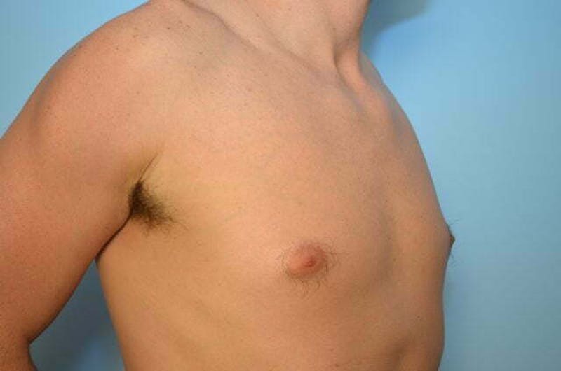 Male Procedures by Dr. Hess Before & After Gallery - Patient 264926 - Image 3