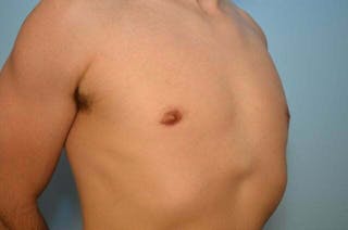 Male Breast Reduction Before & After Gallery - Patient 264926 - Image 4