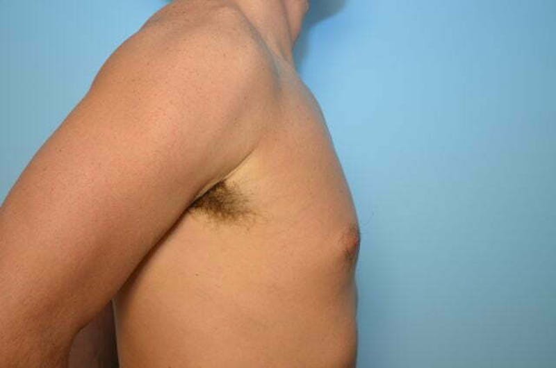 Male Procedures by Dr. Hess Before & After Gallery - Patient 264926 - Image 5