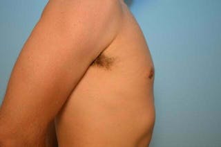 Male Breast Reduction Before & After Gallery - Patient 264926 - Image 6