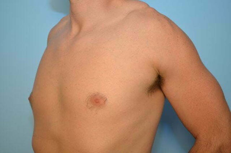 Male Procedures by Dr. Hess Before & After Gallery - Patient 264926 - Image 7