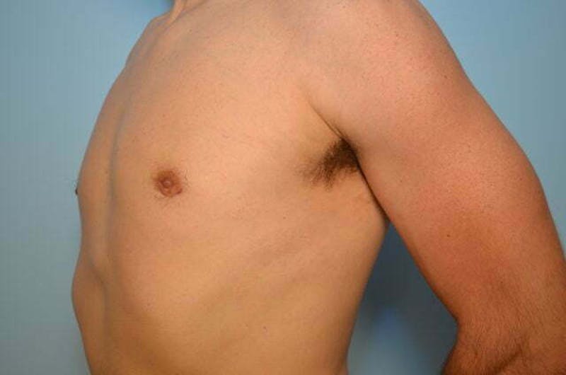 Male Procedures by Dr. Hess Before & After Gallery - Patient 264926 - Image 8