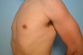 Male Breast Reduction Before & After Gallery - Patient 264926 - Image 8
