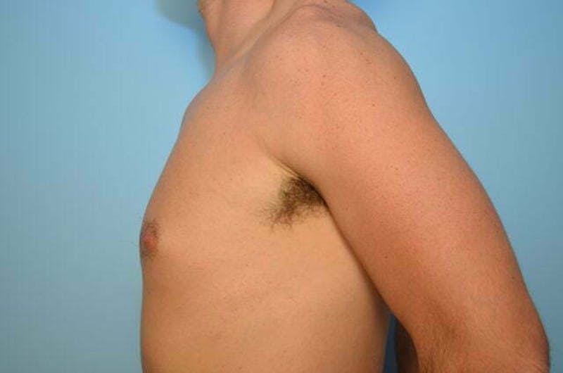 Male Procedures by Dr. Hess Before & After Gallery - Patient 264926 - Image 9