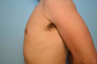 Male Breast Reduction Before & After Gallery - Patient 264926 - Image 10