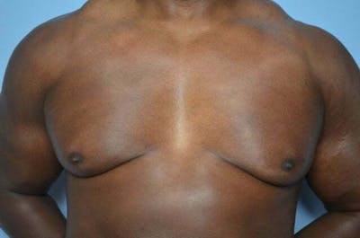 Male Procedures by Dr. Hess Before & After Gallery - Patient 113740 - Image 1