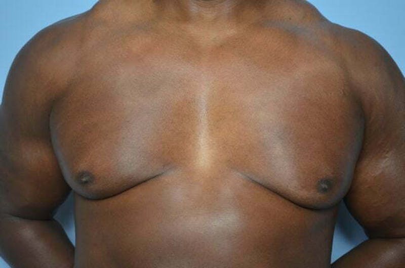 Male Procedures by Dr. Hess Before & After Gallery - Patient 113740 - Image 1