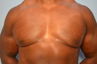 Male Breast Reduction Before & After Gallery - Patient 113740 - Image 2