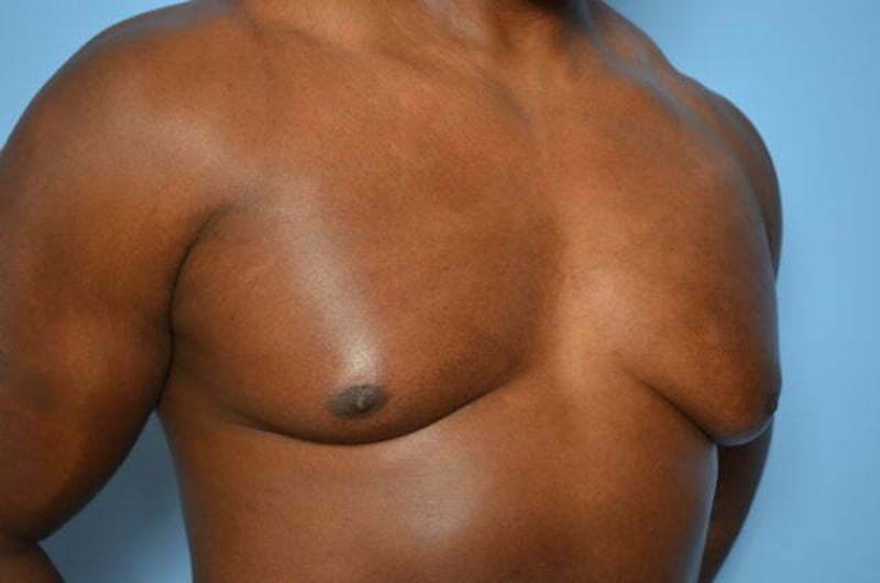 Male Procedures by Dr. Hess Before & After Gallery - Patient 113740 - Image 3