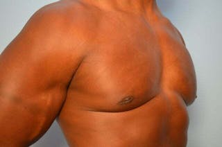 Male Breast Reduction Before & After Gallery - Patient 113740 - Image 4
