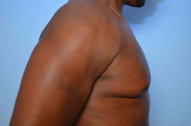 Male Procedures by Dr. Hess Before & After Gallery - Patient 113740 - Image 5
