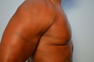 Male Breast Reduction Before & After Gallery - Patient 113740 - Image 6