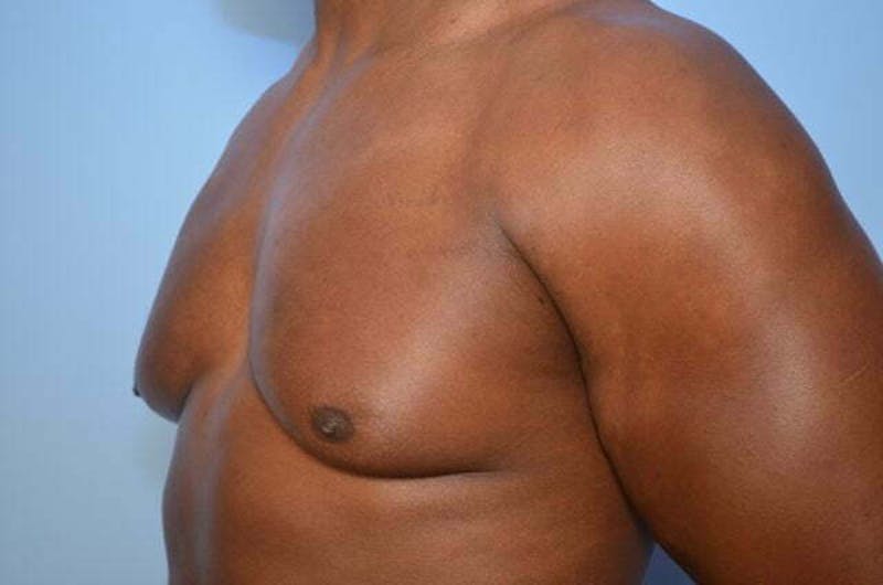 Male Procedures by Dr. Hess Before & After Gallery - Patient 113740 - Image 7