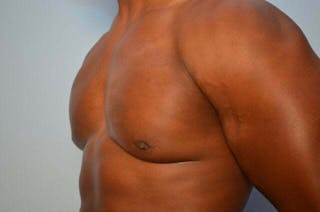Male Breast Reduction Before & After Gallery - Patient 113740 - Image 8