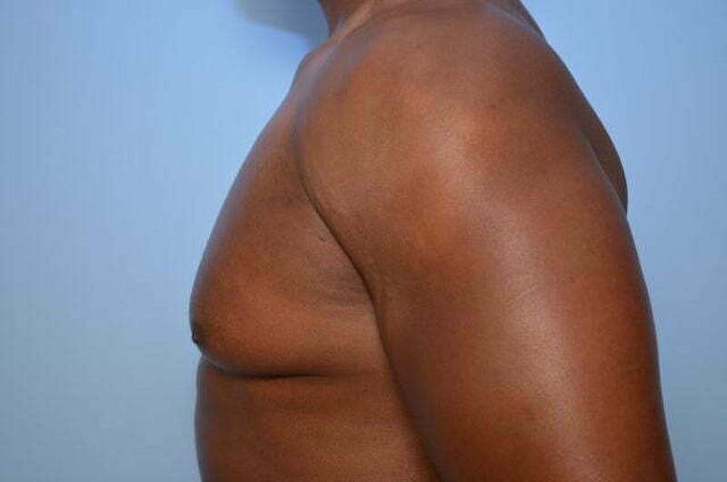 Male Procedures by Dr. Hess Before & After Gallery - Patient 113740 - Image 9
