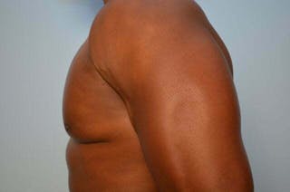 Male Breast Reduction Before & After Gallery - Patient 113740 - Image 10