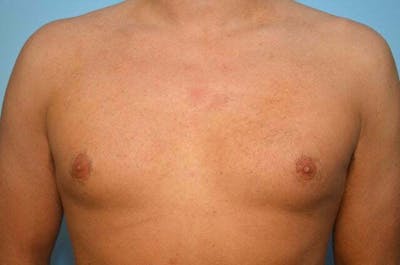Male Procedures by Dr. Hess Before & After Gallery - Patient 124869 - Image 1