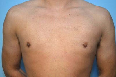 Male Procedures by Dr. Hess Before & After Gallery - Patient 124869 - Image 2