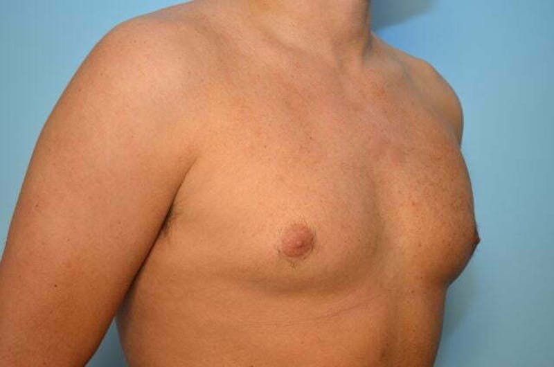 Male Procedures by Dr. Hess Before & After Gallery - Patient 124869 - Image 3