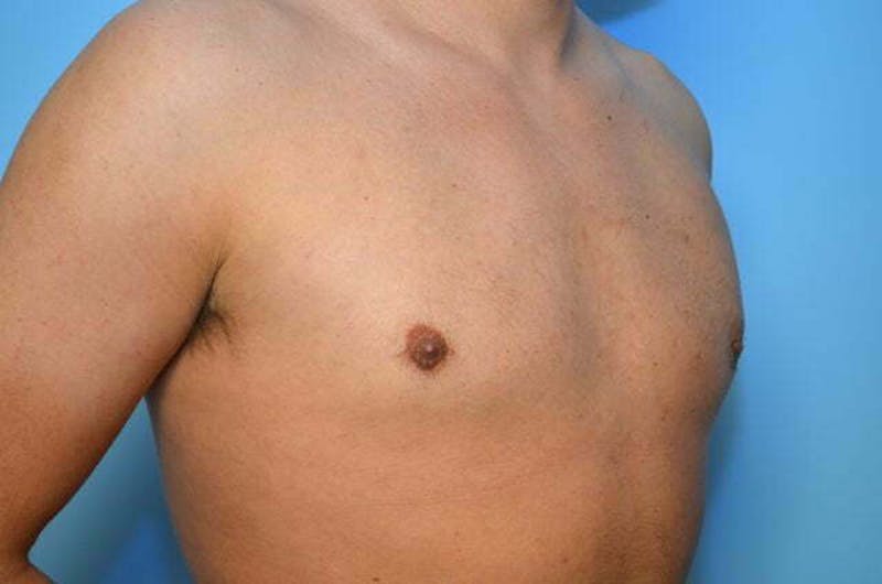 Male Procedures by Dr. Hess Before & After Gallery - Patient 124869 - Image 4