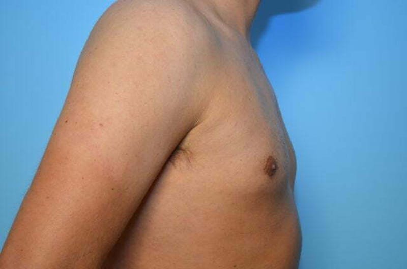 Male Procedures by Dr. Hess Before & After Gallery - Patient 124869 - Image 6