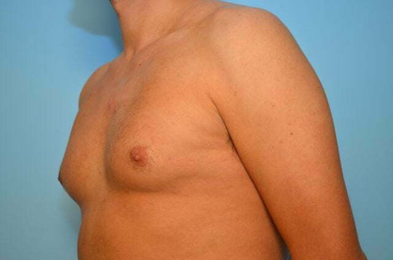 Male Procedures by Dr. Hess Before & After Gallery - Patient 124869 - Image 7