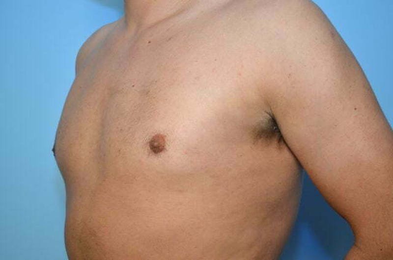 Male Procedures by Dr. Hess Before & After Gallery - Patient 124869 - Image 8