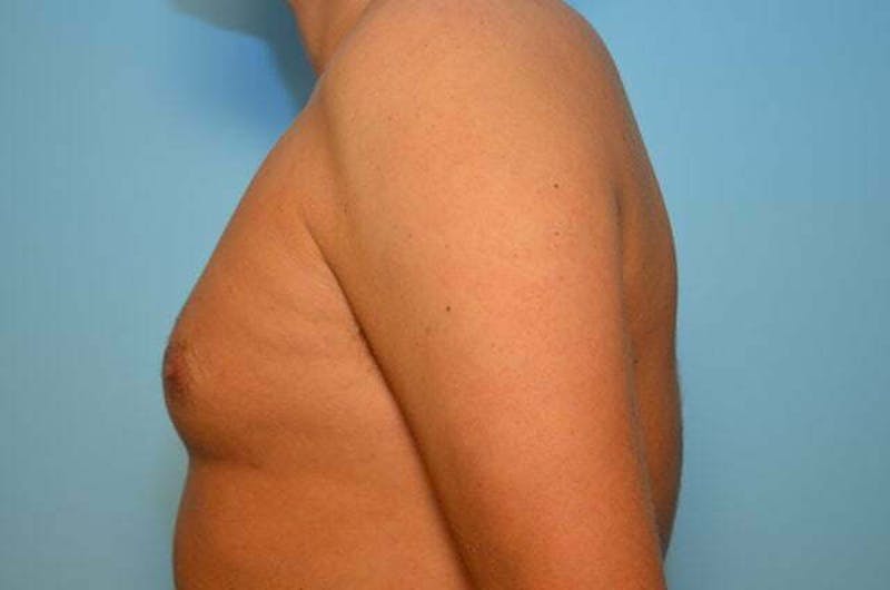 Male Procedures by Dr. Hess Before & After Gallery - Patient 124869 - Image 9