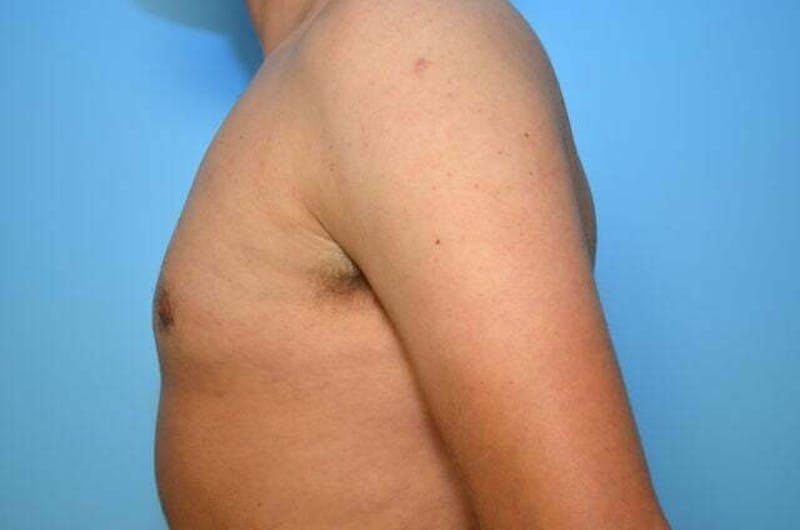 Male Procedures by Dr. Hess Before & After Gallery - Patient 124869 - Image 10