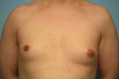Male Procedures by Dr. Hess Before & After Gallery - Patient 276924 - Image 1