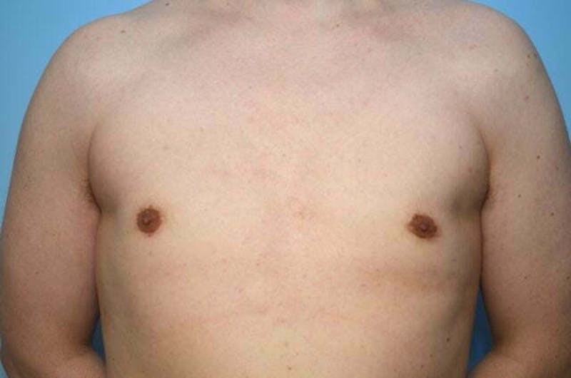 Male Procedures by Dr. Hess Before & After Gallery - Patient 276924 - Image 2