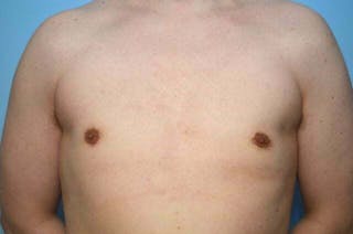 Male Breast Reduction Before & After Gallery - Patient 276924 - Image 2