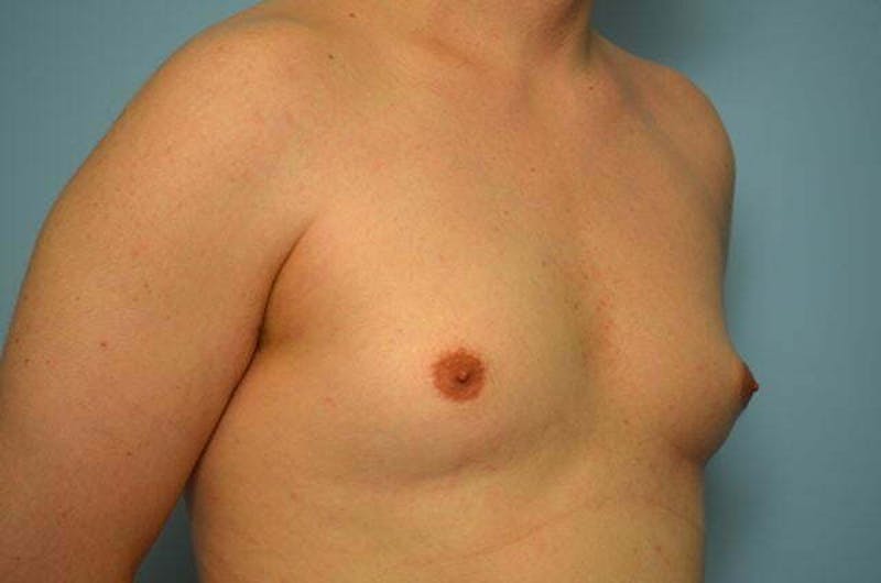 Male Procedures by Dr. Hess Before & After Gallery - Patient 276924 - Image 3