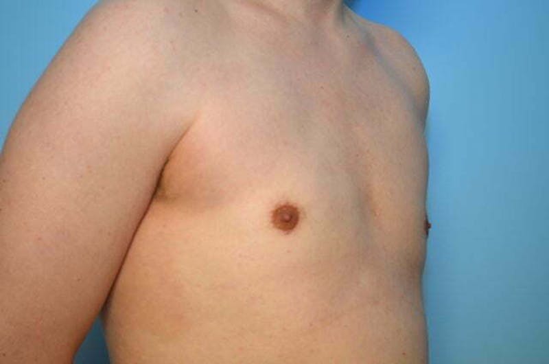 Male Procedures by Dr. Hess Before & After Gallery - Patient 276924 - Image 4