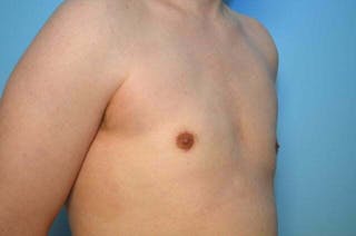 Male Breast Reduction Before & After Gallery - Patient 276924 - Image 4
