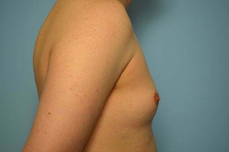 Male Procedures by Dr. Hess Before & After Gallery - Patient 276924 - Image 5