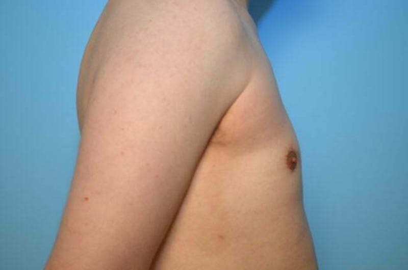 Male Procedures by Dr. Hess Before & After Gallery - Patient 276924 - Image 6