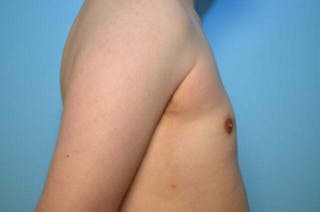 Male Breast Reduction Before & After Gallery - Patient 276924 - Image 6