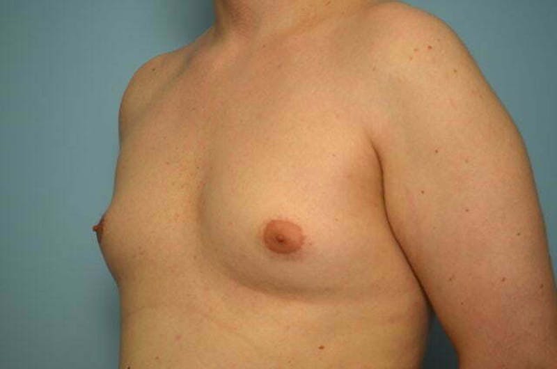 Male Procedures by Dr. Hess Before & After Gallery - Patient 276924 - Image 7