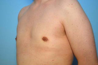 Male Breast Reduction Before & After Gallery - Patient 276924 - Image 8