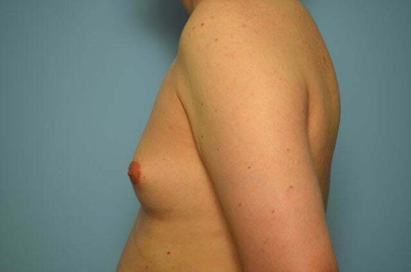 Male Procedures by Dr. Hess Before & After Gallery - Patient 276924 - Image 9