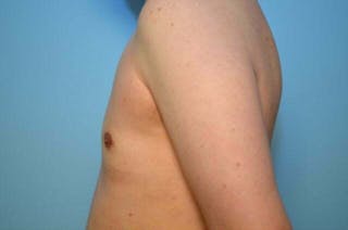 Male Breast Reduction Before & After Gallery - Patient 276924 - Image 10